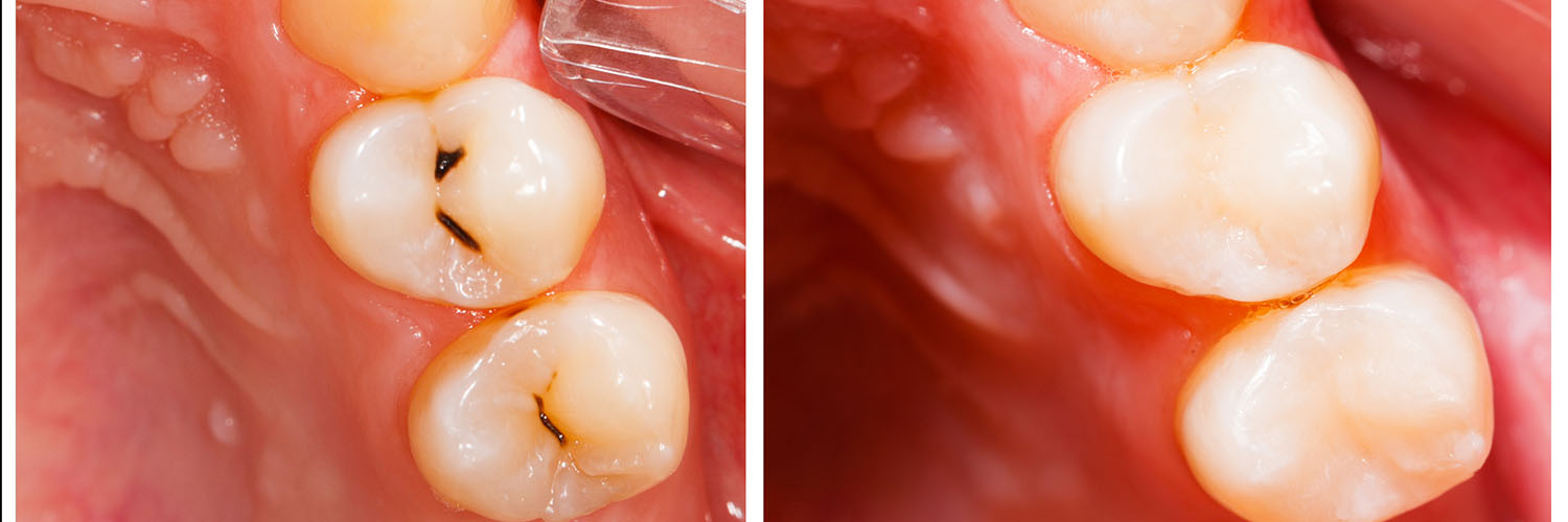 Elite Dentistry | Periodontal Treatment, Inlays  amp  Onlays and Oral Cancer Screening