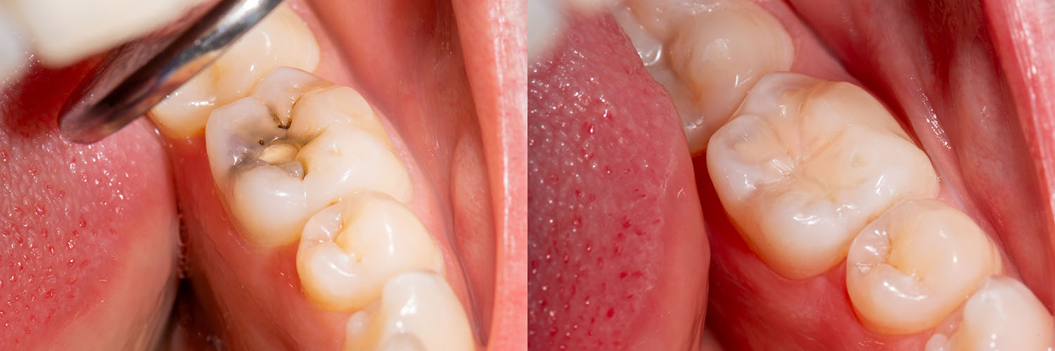 Elite Dentistry | Inlays  amp  Onlays, Extractions and LANAP reg